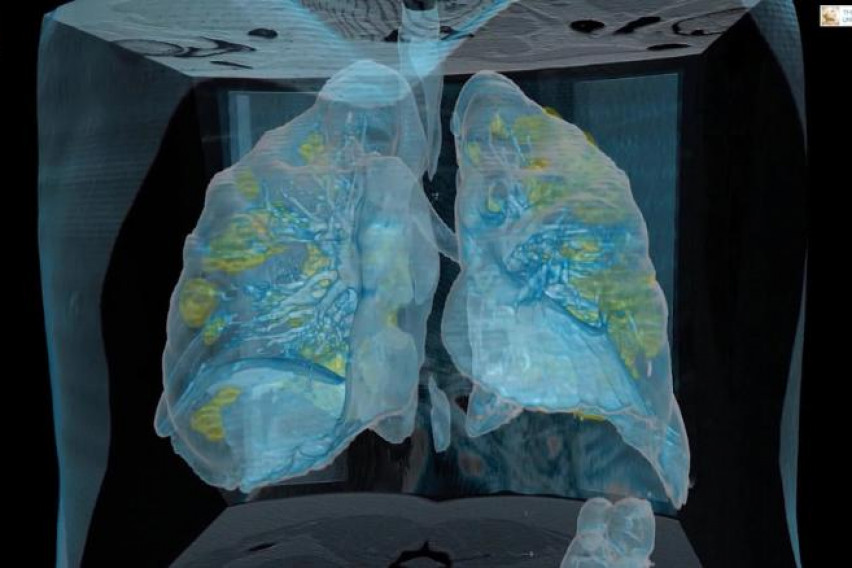 Погледнете како изгледаат белите дробови на заразен пациент од коронавирус (ВИДЕО)