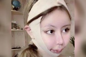 Тинејџерка од Кина станала зависна од естетски операции, затоа што се плашела дека ќе остане грда