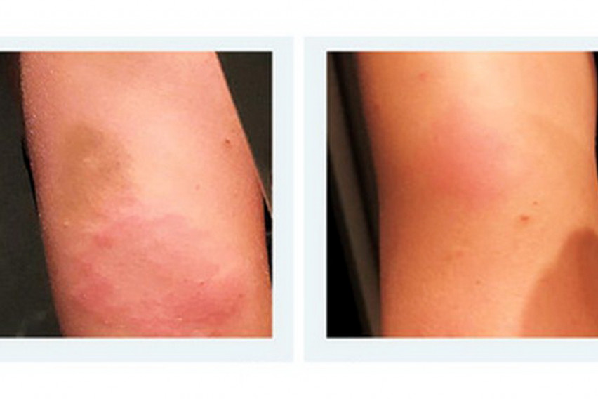 По примање на оваа вакцина луѓето добиле осип: Што е „ковид рака“ и дали има причини за страв?