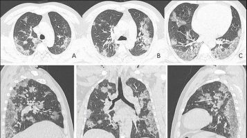 Грчки пулмолог објавил шокантни снимки од белите дробови на малолетници со Ковид-19