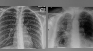 Рендгенски снимки покажуваат како вакцината ги штити белите дробови од Ковид-19