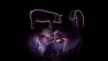 Во САД е извршена првата трансплантација на бубрег од свиња во човек