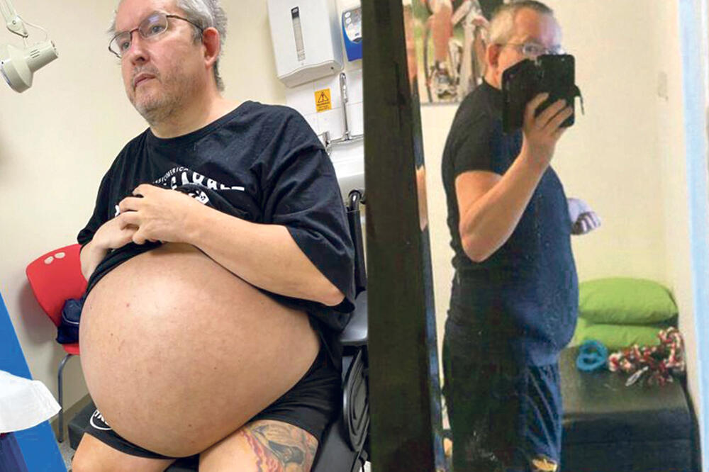 На Британец докторите му извадиле бубрези што тежеле 35 килограми