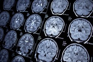 Ковид-19 може да предизвика влошување на извршните функции на мозокот и негово намалување