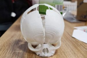 Бебе било спасено откако со 3Д принтер бил направен дел од черепот