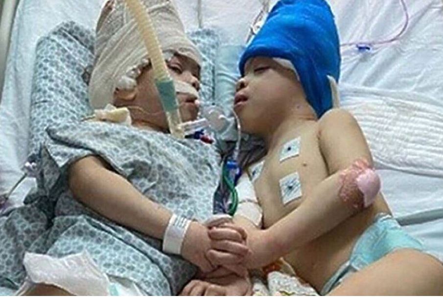 Во Бразил, со помош на виртуелна реалност одвоија споени близнаци