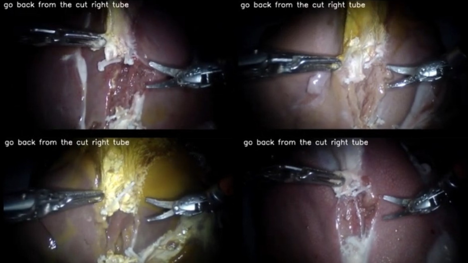 (Видео) Робот изврши операција целосно самостојно слушајќи ги упатствата на хирургот