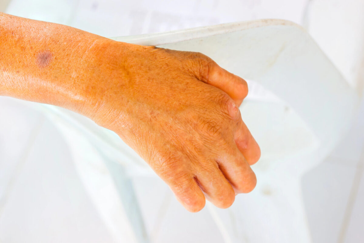 Романија потврди два случаи на лепра, првпат по 40 години