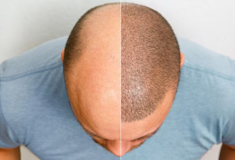 Револуција во најавa: едноставен гел од „шеќер на ДНК“ покажува моќ да ја врати косата